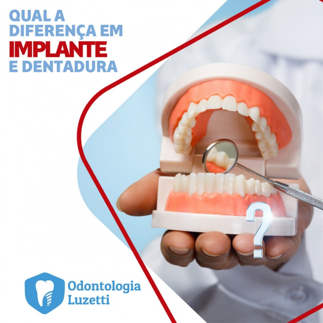 Implante VS Dentadura 